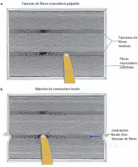 Illustration d’un faisceau de fibres tendues, de points de déclenchement myofasciaux et d’une réaction de contraction locale dans une section transversale du muscle.