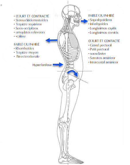 Cyphose dorsale et l'ostéopathie - OsteoMag