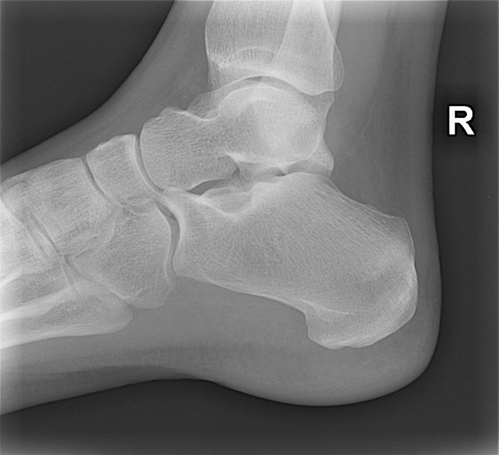 Calcaneal Stress Fracture OsteoMag Calcaneal Stress Fracture OsteoMag
