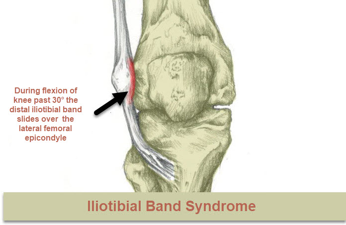 Iliotibial Band Syndrome Itbs Of The Knee Osteomag 9374