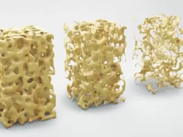 Osteoporosis front