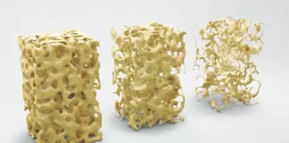 Osteoporosis front