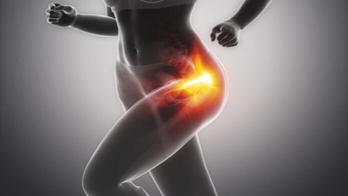 hip trochanteric bursitis