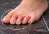 How Osteopathy Can Treat Claw Toes Effectively