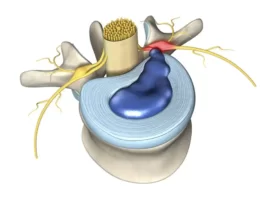 cervical spine radiculopathy
