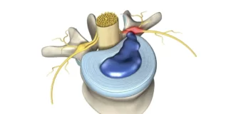 cervical spine radiculopathy