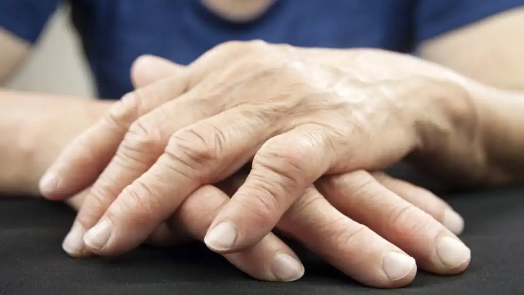 woman s hands displaying rheumatoid arthritis x 