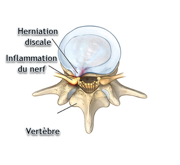 Cervical radiculopathy (pinched nerve in neck) | OsteoMag