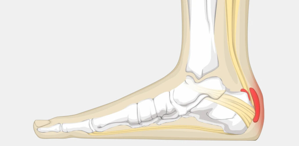 Retrocalcaneal bursitis | OsteoMag