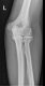 Elbow osteoarthritis x-ray