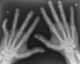 psoriatic arthritis of hands