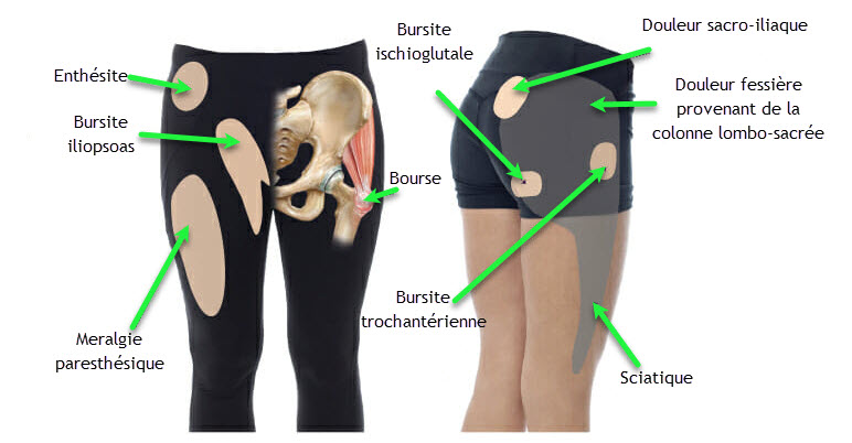 bursitis labeled2 | OsteoMag