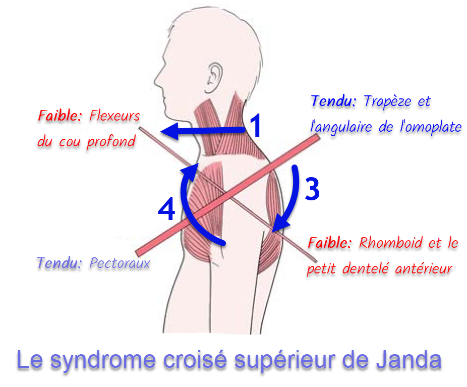 Le Syndrome Croisé Supérieur de Janda Approche Ostéopathique OsteoMag — free download
