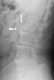 Osteophyte x-ray