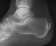 Achilles_insertional_calcific_tendinosis