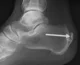 Achilles_insertional_calcific_tendinosis a (1)