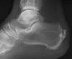 Achilles_insertional_calcific_tendinosis a