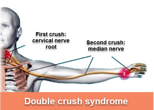 Carpal tunnel syndrome | OsteoMag