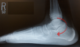 Figure 2 C Sign Talo Calcaneal Coalition 600×351 1