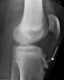 Radiograph of human knee with Osgood–Schlatter disease