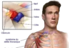 Thoracic Outlet Syndrome  