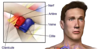 Thoracic Outlet Syndrome  