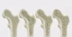 bones in the stages of osteoporosis