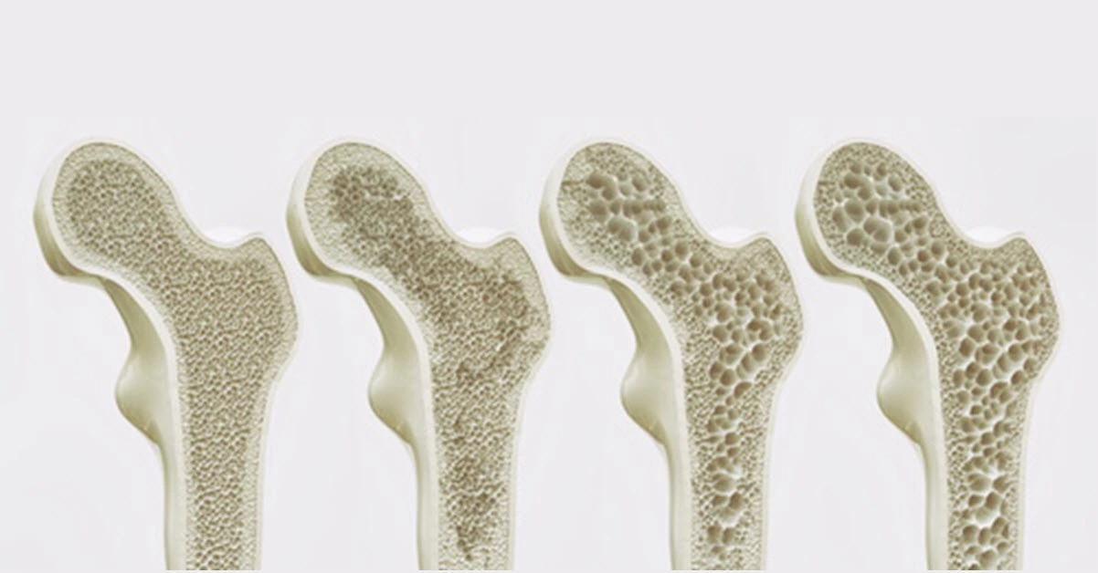 bones in the stages of osteoporosis 