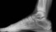 calcaneal apophysis xray