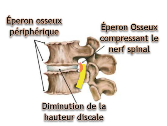 Cervical radiculopathy (pinched nerve in neck) | OsteoMag