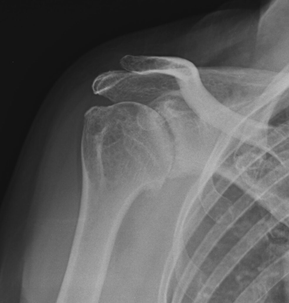 glenohumeral degenerative joint disease 386×405 1 | OsteoMag