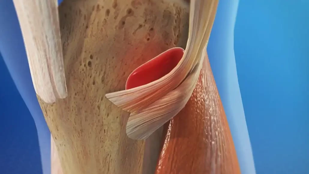 Image actuelle : goosefootbursitis 1280 1280x640 1