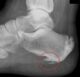 heel spur