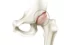 osteoarthritis-hip800-800×426-1_18_11zon