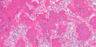 osteoid osteoma