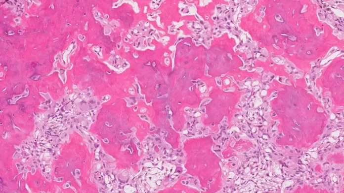 osteoid osteoma
