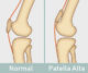 patella alta position 1