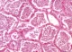 pathology_lobarpneumonia10x04_3_11zon