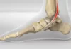 posterior tibial tendon syndrome