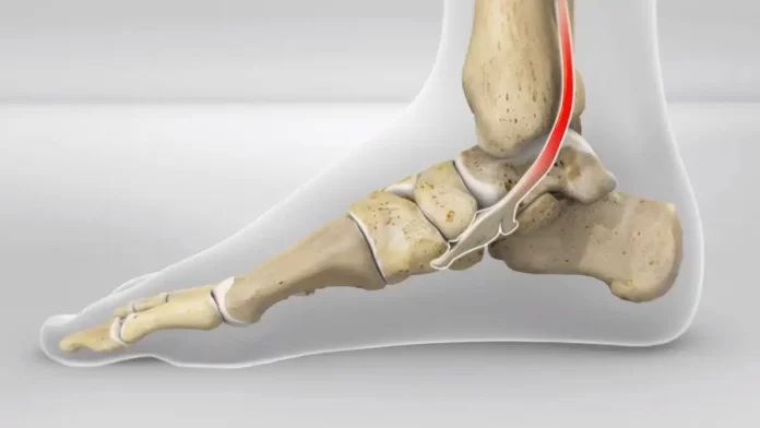 posterior tibial tendon syndrome