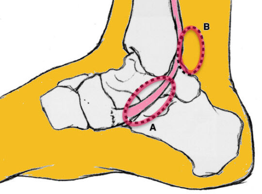 Posterior Tibial Tendon Dysfunction | OsteoMag