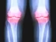 732×549 OA of the knee x ray