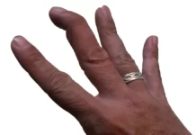 Mallet Finger Injury