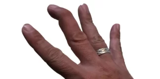 Mallet Finger Injury