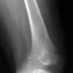 ewing sarcoma distal femur