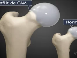 femoroacetabular impingement