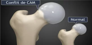 femoroacetabular impingement