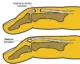 mallet finger tendon rupture injury hand therapy 2