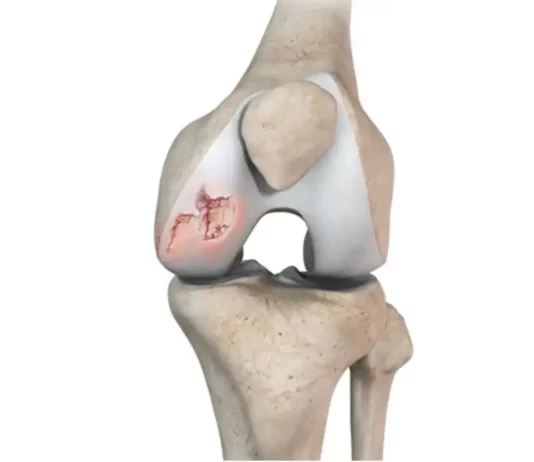 osteochondritis