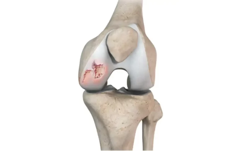 osteochondritis